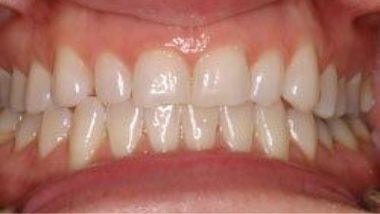 Close up of imperfect teeth before dental treatment