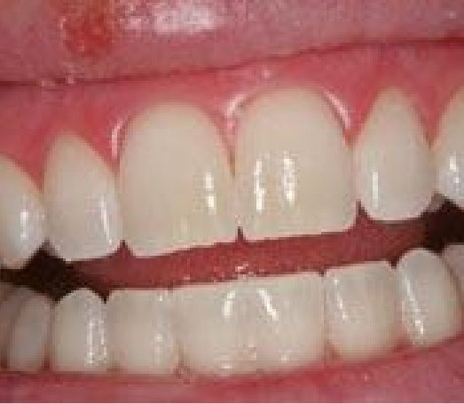 Close up of smile with straight white teeth