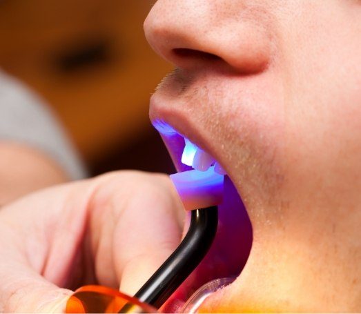 Close up of man getting cosmetic dental bonding on his front tooth