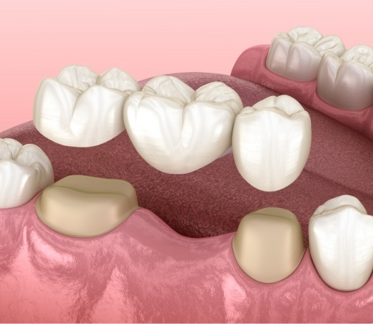 Animated dental bridge replacing one missing tooth