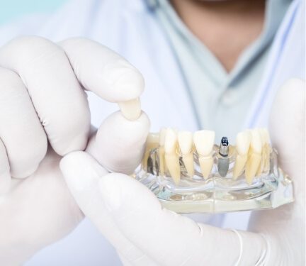 Dentist holding a dental crown in one hand and a dental implant model in the other