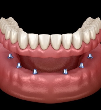 Animated implant denture being placed onto six dental implants
