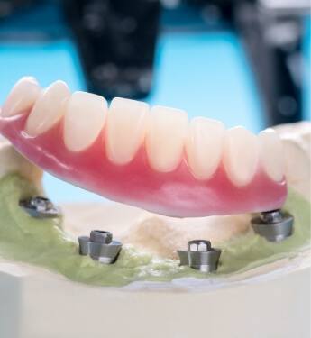 Model of an implant denture