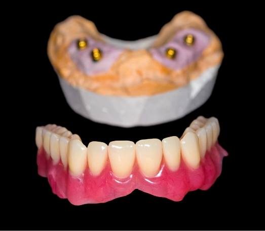 Model of implant dentures against black background