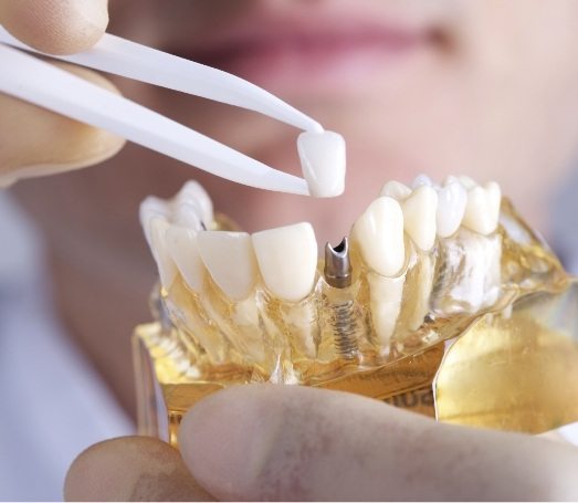 Dentist placing a dental crown over a dental implant in model of mouth