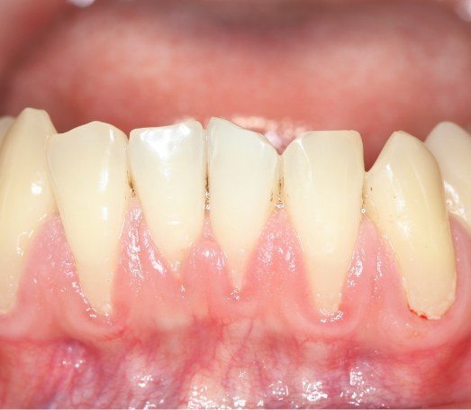 Close up of long teeth needing gum recession treatment in Los Angeles