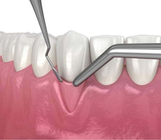 Animated gum graft