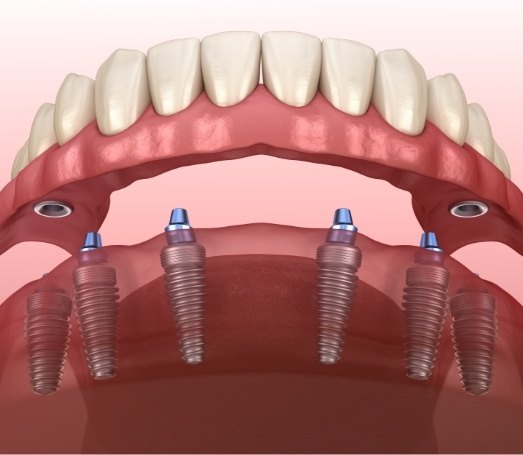 Animated implant denture in Los Angeles being placed on lower arch