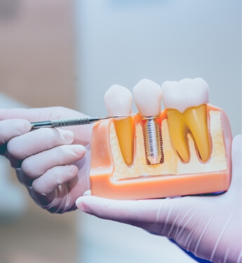 Dentist pointing to a model of a dental implant in the jaw