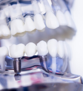 Model of the mouth with a dental implant bridge