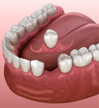 Animated partial denture being placed in space of missing tooth