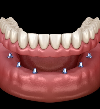 Animated implant denture being fitted onto six dental implants