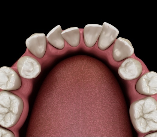Animated row of crowded teeth on lower arch