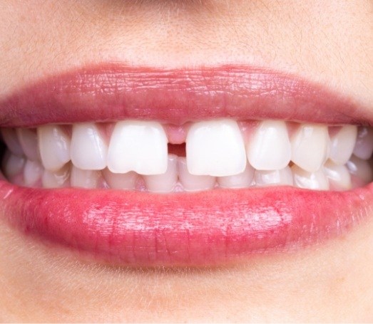 calculating cost of Invisalign in Los Angeles