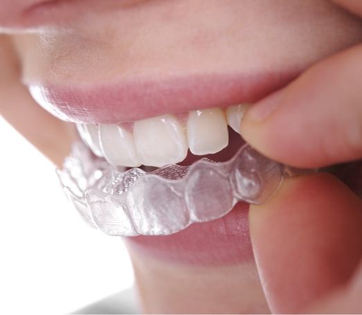 Close up of person placing Invisalign aligner over their teeth