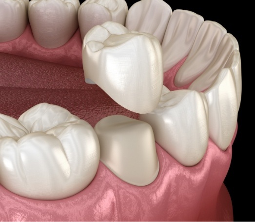 Animated dental crown being fitted over a tooth