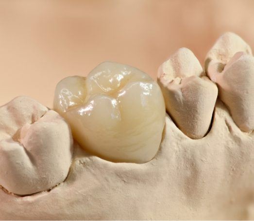 All porcelain dental crown over a tooth in model of the mouth