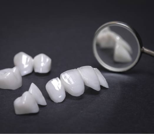 Several dental inlays and onlays laying on tray with dental mirror