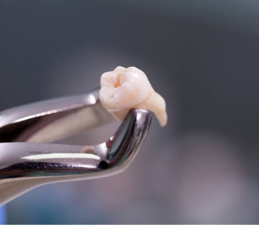 Dental forceps holding an extracted tooth