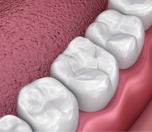 Animated close up of tooth with a seamless tooth colored filling