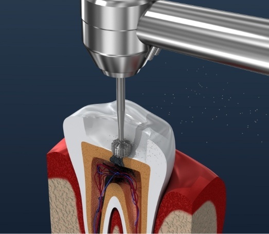 Animated dental instrument cleaning the inside of a tooth during root canal treatment