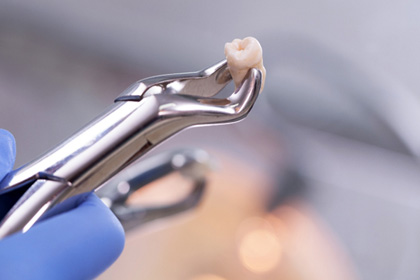 Extracted tooth held by dental pliers 