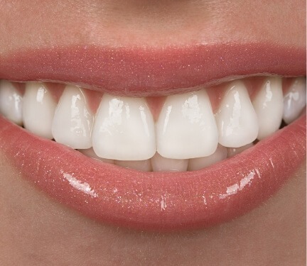 Close up of smile with straight white teeth