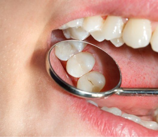 Close up of dental mirror reflecting tooth colored filling in mouth