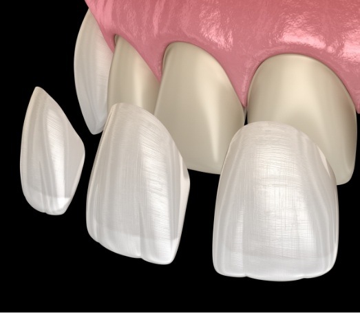 Three animated veneers being placed over front teeth