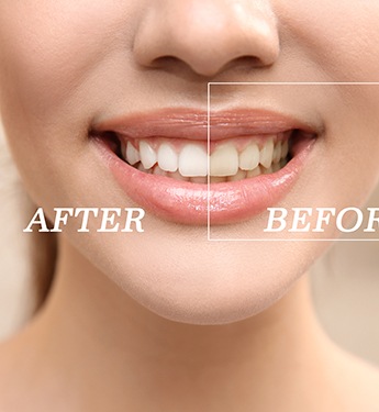 Nose-to-neck view of woman smiling with teeth half whitened to show before/after results