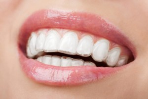 smile with los angeles invisalign alignment trays