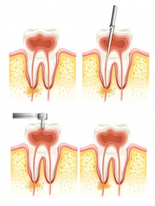 Illustration of a Dental root canal deterioration on a white background