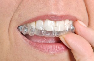 los angeles invisalign