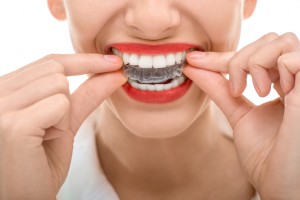 Invisalign in Los Angeles