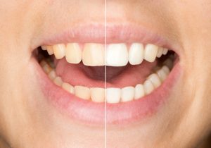 Your dentist for teeth whitening in Los Angeles.