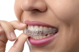 With Invisalign in West Los Angeles, you can make someone’s smile beautiful. 