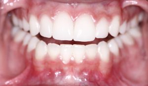 Receding gums in Los Angeles can be treated. 