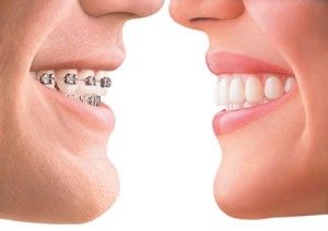 Invisalign vs Traditional Braces In LA