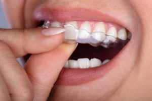 close up of a person putting Invisalign aligner on their top teeth 