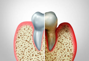 Normal gums compared to gum disease